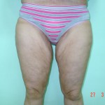 lifting cosce