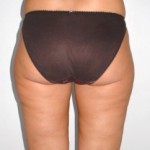 LIPOASPIRAZIONE LIPOSUZIONE CHIRURGO PLASTICO NAPOLI