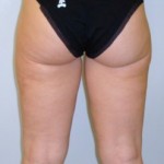 LIPOASPIRAZIONE LIPOSUZIONE CHIRURGO PLASTICO NAPOLI