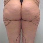 LIPOASPIRAZIONE LIPOSUZIONE CHIRURGO PLASTICO NAPOLI