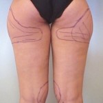 LIPOASPIRAZIONE LIPOSUZIONE CHIRURG0 PLASTICO NAPOLI
