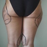LIPOASPIRAZIONE LIPOSUZIONE CHIRURGO PLASTICO NAPOLI