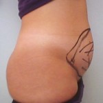 LIPOASPIRAZIONE LIPOSUZIONE CHIRURGO PLASTICO NAPOLI