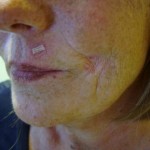 LIPOFILLING CHIRURGO ESTETICO NAPOLI