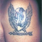 asportazione tatuaggio con laser q-switched