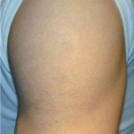 asportazione tatuaggio con laser q-switched