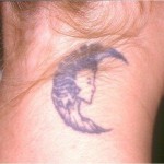 asportazione tatuaggio con laser q-switched