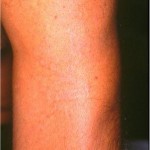asportazione tatuaggio con laser q-switched
