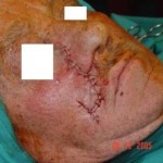 Tumori della pelle chirurgia plastica napoli